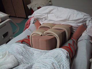 Benefits of a Hip Abduction Pillow After Total Hip Replacement Surgery 