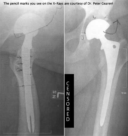 Ben Goldfarb's 12-month Hip Replacement X-Ray